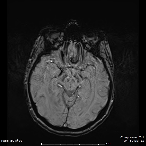 File:Anterior temporal lobe perivascular space (Radiopaedia 88283-104914 Axial SWI 19).jpg