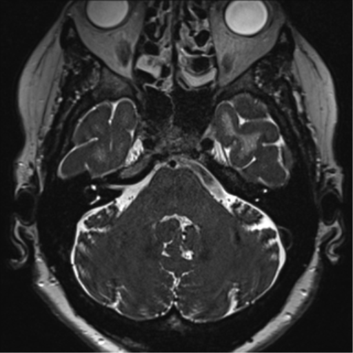 Anterior temporal pole cysts (Radiopaedia 46629-51102 Axial 7).png