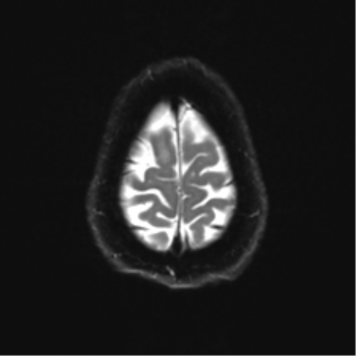 Anterior temporal pole cysts (Radiopaedia 46629-51102 Axial DWI 25).png