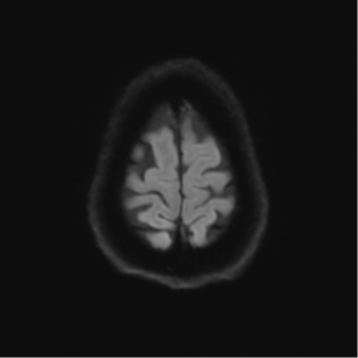 Anterior temporal pole cysts (Radiopaedia 46629-51102 Axial DWI 52).png