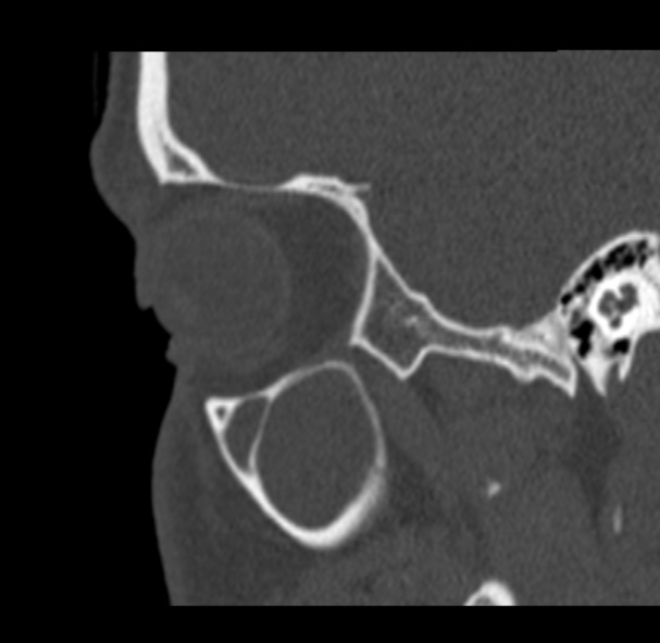 Antrochoanal polyp (Radiopaedia 33984-35202 Sagittal bone window 13).jpg