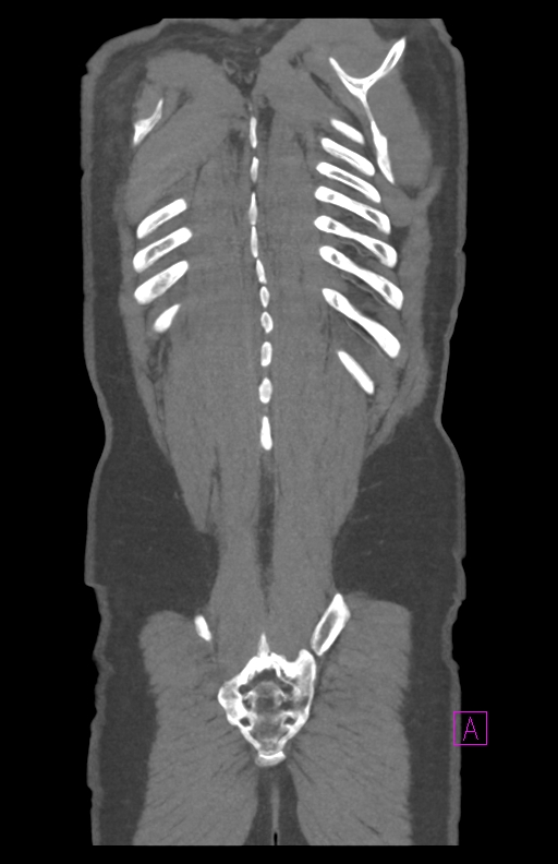 Aortectomy and axillary-bifemoral bypass (Radiopaedia 28303-28545 C 84).jpg
