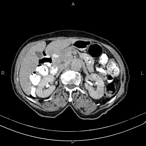 Aortic aneurysm and Lemmel syndrome (Radiopaedia 86499-102554 Axial C+ delayed 30).jpg