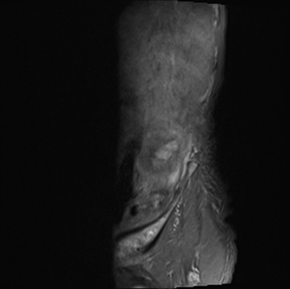 File:Aortic aneurysm with spinal destruction (Radiopaedia 42301-45409 Sagittal T1 fat sat 2).jpg