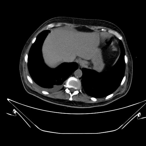 File:Aortic arch aneurysm (Radiopaedia 84109-99365 Axial non-contrast 240).jpg