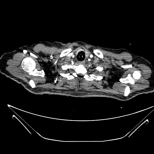 Aortic arch aneurysm (Radiopaedia 84109-99365 B 51).jpg