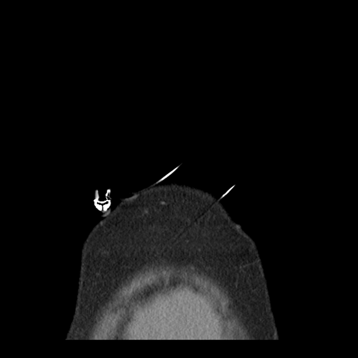 Aortic arch graft infection (FDG PET-CT) (Radiopaedia 71975-82437 Coronal 3).jpg