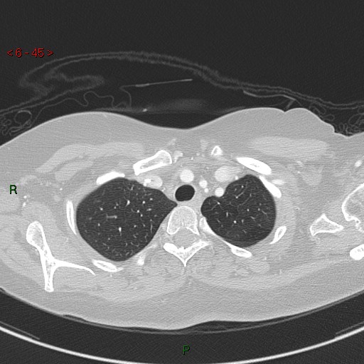 File:Aortic arch origin of left vertebral artery (Radiopaedia 51520-57286 Axial lung window 45).jpg