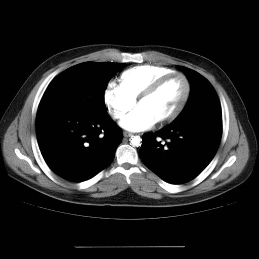 File:Aortic arch stent (Radiopaedia 30030-30595 D 25).jpg