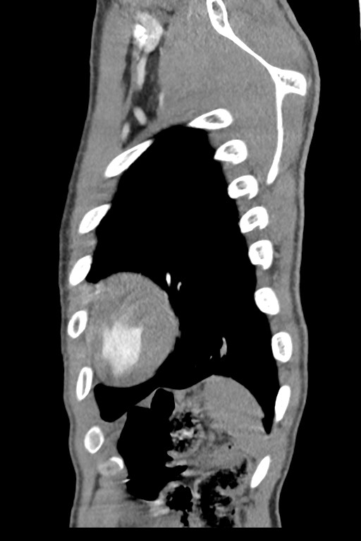 Aortic coarctation with aneurysm (Radiopaedia 74818-85828 B 139).jpg