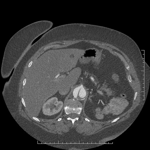 Aortic dissection- Stanford A (Radiopaedia 35729-37268 B 40).jpg