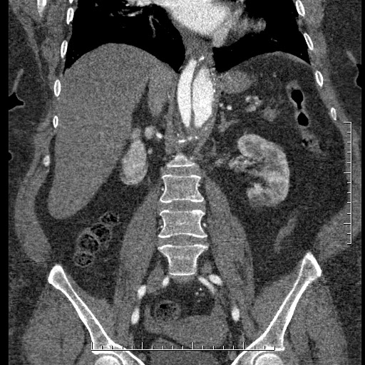 File:Aortic dissection- Stanford A (Radiopaedia 35729-37268 F 23).jpg
