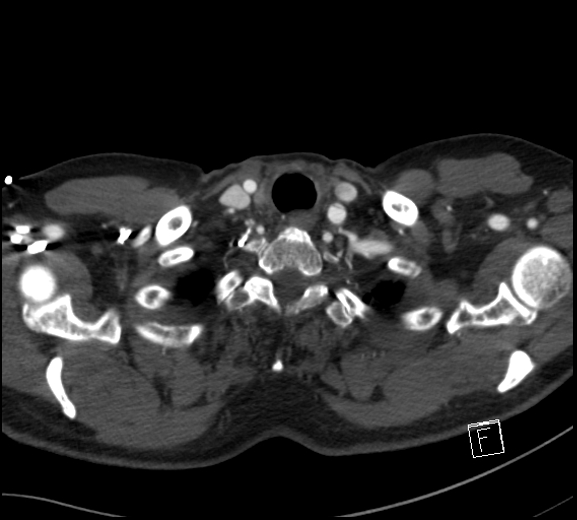 File:Aortic dissection (CTPA) (Radiopaedia 75506-86750 A 5).jpg