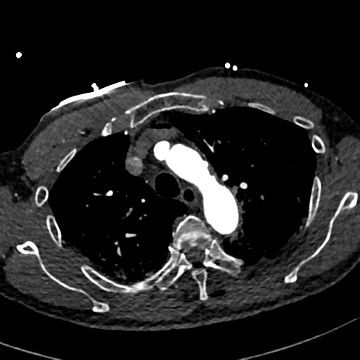 File:Aortic dissection - DeBakey type II (Radiopaedia 64302-73082 A 25).png