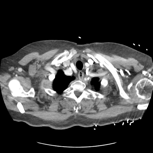 File:Aortic dissection - Stanford type B (Radiopaedia 50171-55512 A 5).png