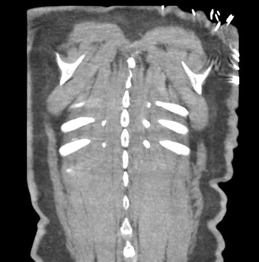 Aortic dissection - Stanford type B (Radiopaedia 50171-55512 B 79).png