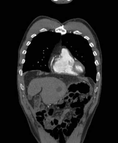 File:Aortic dissection - Stanford type B (Radiopaedia 73648-84437 B 26).jpg