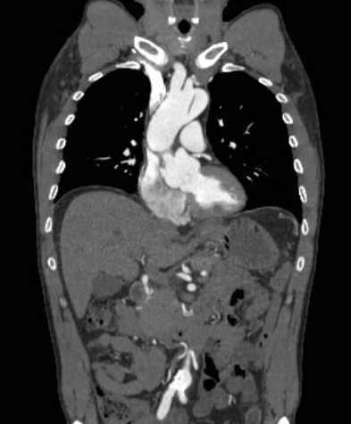 File:Aortic dissection - Stanford type B (Radiopaedia 73648-84437 B 48).jpg