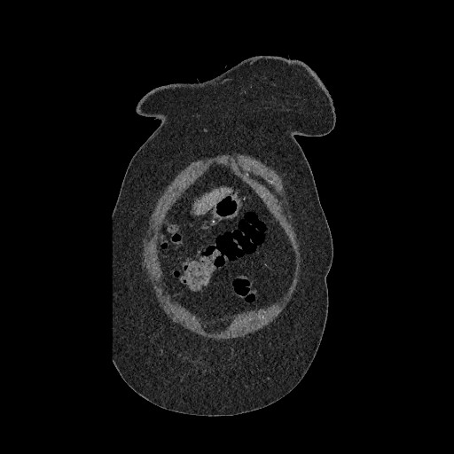 Aortic dissection - Stanford type B (Radiopaedia 88281-104910 B 4).jpg