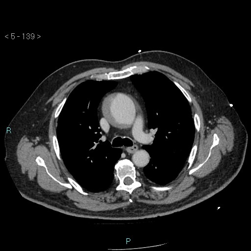 File:Aortic intramural hematoma (Radiopaedia 48463-53380 C 63).jpg