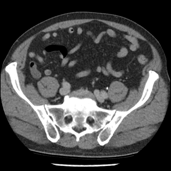 Aortic intramural hematoma (type B) (Radiopaedia 79323-92387 Axial C+ delayed 93).jpg