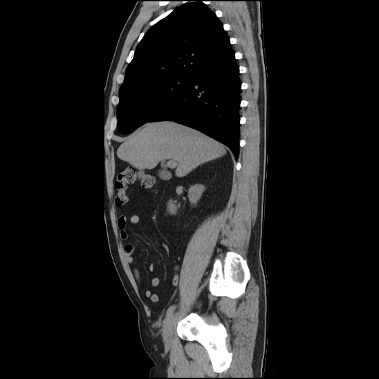 Aortic intramural hematoma (type B) (Radiopaedia 79323-92387 G 13).jpg