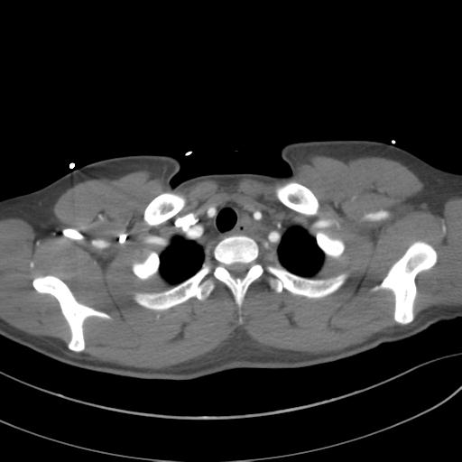 File:Aortic transection (Radiopaedia 29890-30405 A 15).jpg