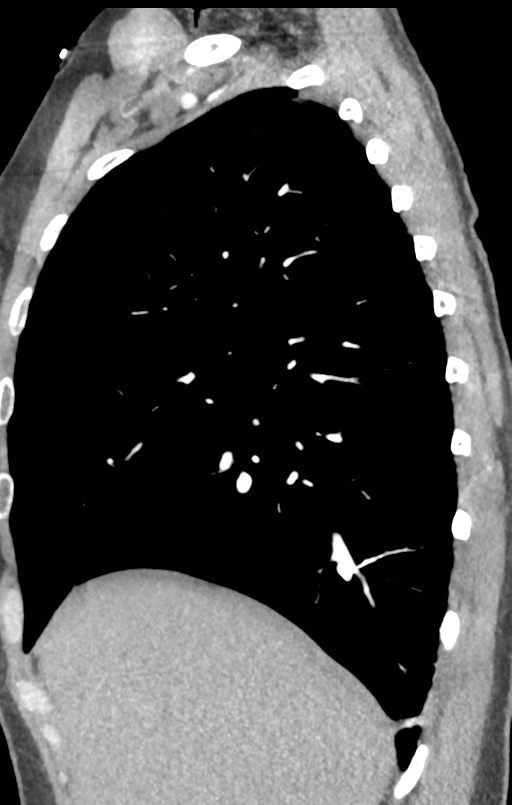 Aortic valve non-coronary cusp thrombus (Radiopaedia 55661-62189 C+ arterial phase 53).png