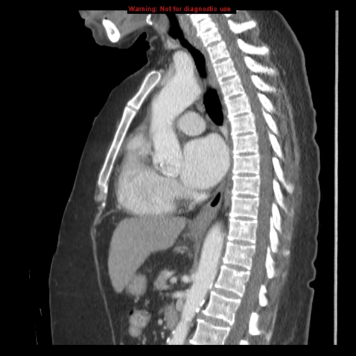 File:Aortic valve stenosis (Radiopaedia 14480-14423 B 1).jpg