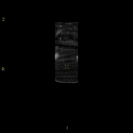File:Aortoiliac occlusive disease (Radiopaedia 16828-16548 B 4).jpg