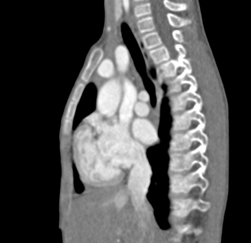 File:Aortopulmonary window, interrupted aortic arch and large PDA giving the descending aorta (Radiopaedia 35573-37074 C 8).jpg
