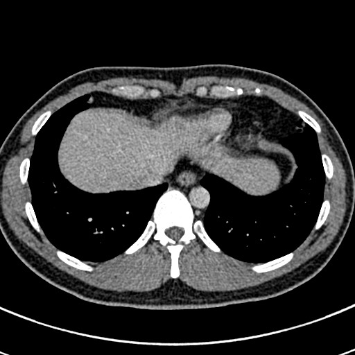 File:Apical lung mass mimic - neurogenic tumor (Radiopaedia 59918-67521 A 66).jpg