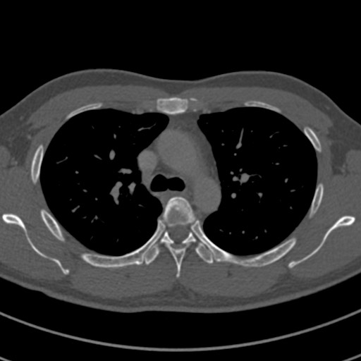Apical lung mass mimic - neurogenic tumor (Radiopaedia 59918-67521 Axial bone window 29).jpg