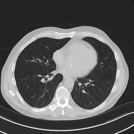 Apical pulmonary metastasis (Radiopaedia 46338-50754 Axial non-contrast 40).png