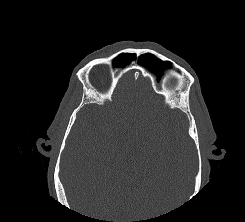 Aplastic maxillary sinuses (Radiopaedia 60030-67561 Axial non-contrast 57).jpg