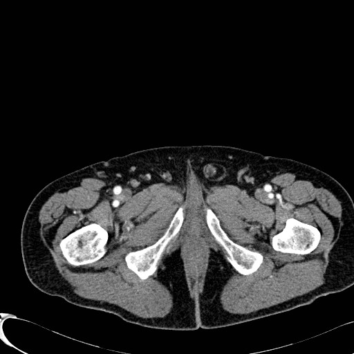 Appendiceal adenocarcinoma complicated by retroperitoneal abscess (Radiopaedia 58007-65039 B 154).jpg