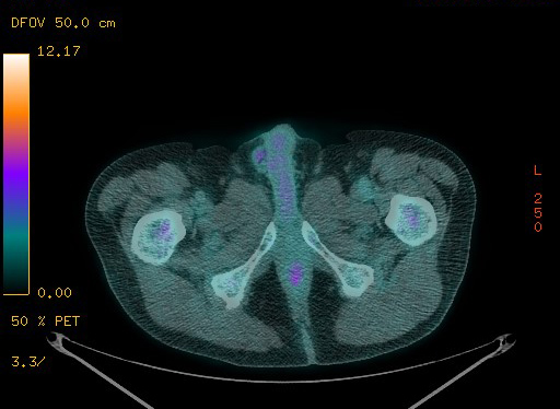 Appendiceal adenocarcinoma complicated by retroperitoneal abscess (Radiopaedia 58007-65041 Axial PET-CT 199).jpg