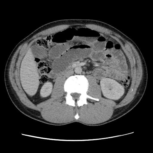 Appendicitis complicated by post-operative collection (Radiopaedia 35595-37114 A 40).jpg