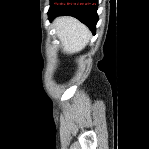 File:Appendicitis mass in inguinal hernia (Radiopaedia 26858-27029 C 1).jpg