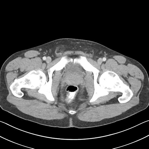 File:Appendicitis with cecal bar sign (Radiopaedia 31878-32830 B 80).jpg