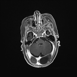 Aqueductal stenosis (Radiopaedia 73974-84802 Axial T1 C+ 54).jpg