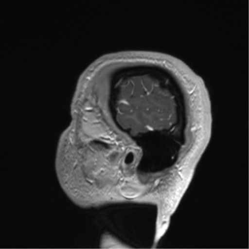 Arachnoid cyst with subdural hematoma (Radiopaedia 85892-101743 Sagittal T1 C+ 84).png