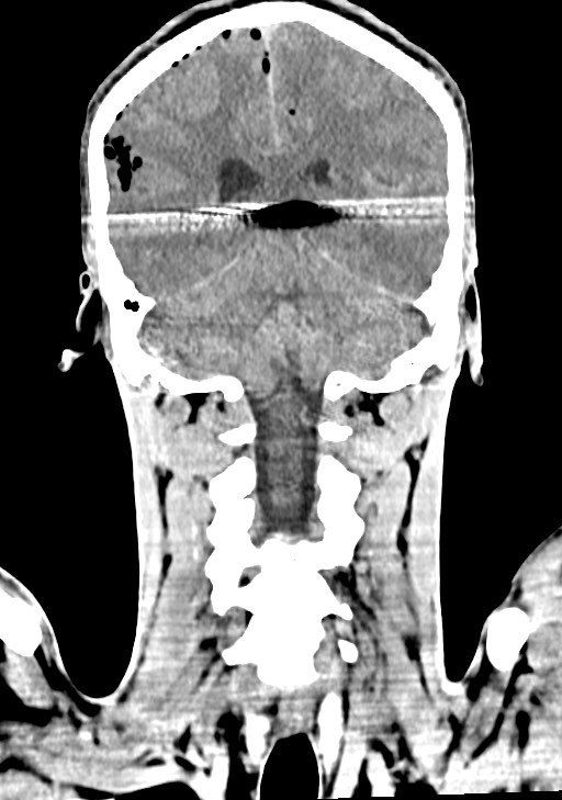 Arrow injury to the brain (Radiopaedia 72101-82607 Coronal non-contrast 50).jpg