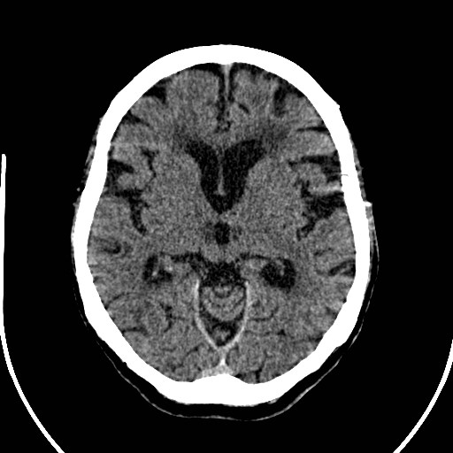 File:Artery of Percheron infarction (Radiopaedia 26307-26438 Axial non-contrast 15).jpg