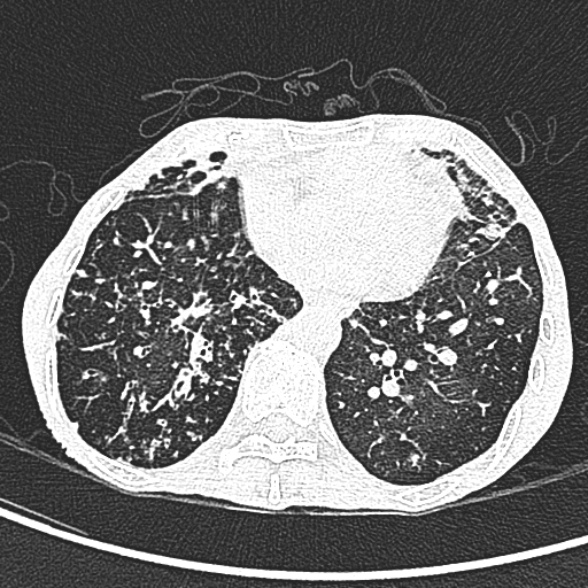 File:Aspergilloma- with Monod sign (Radiopaedia 44737-48532 Axial lung window 190).jpg