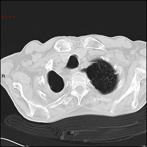 File:Aspergilloma (Radiopaedia 14842-14787 Axial lung window 6).jpg