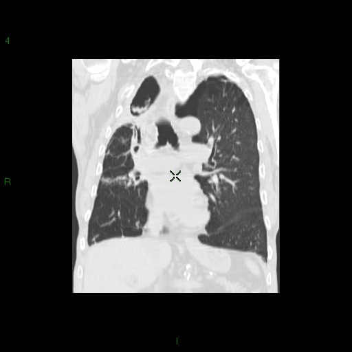 File:Aspergilloma (Radiopaedia 14842-14787 Coronal lung window 18).jpg