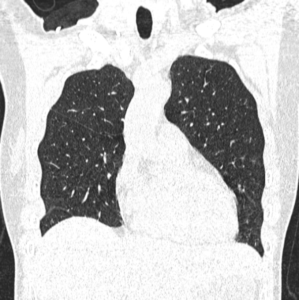 File:Aspergilloma (Radiopaedia 26223-26347 Coronal lung window 15).jpg