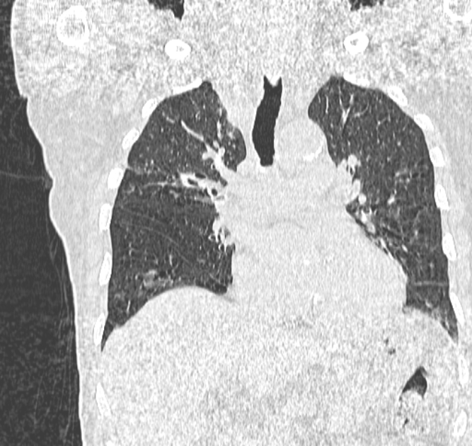 Aspergilloma (Radiopaedia 44592-48327 Coronal lung window 57).jpg