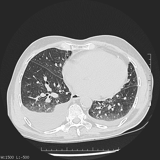 Aspergilloma (Radiopaedia 75184-86270 Axial lung window 35).jpg